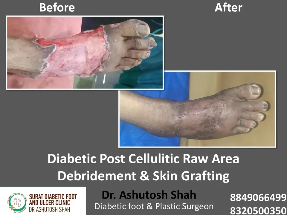 Diabetic Foot  PPT sunita.pptx-35.webp